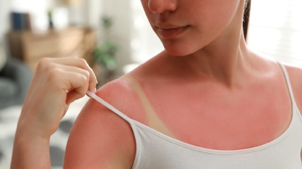 Lavender oil is the best essential oil for treating sunburn